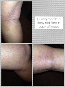 7 month flare